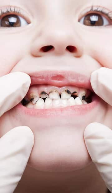 Tips to Manage Cavities in Kids and Protect Growing Teeth