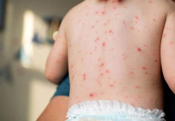 Climate shift linked to rise in chickenpox and mumps among TN students
